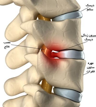 بالش مناسب برای دیسک گردن